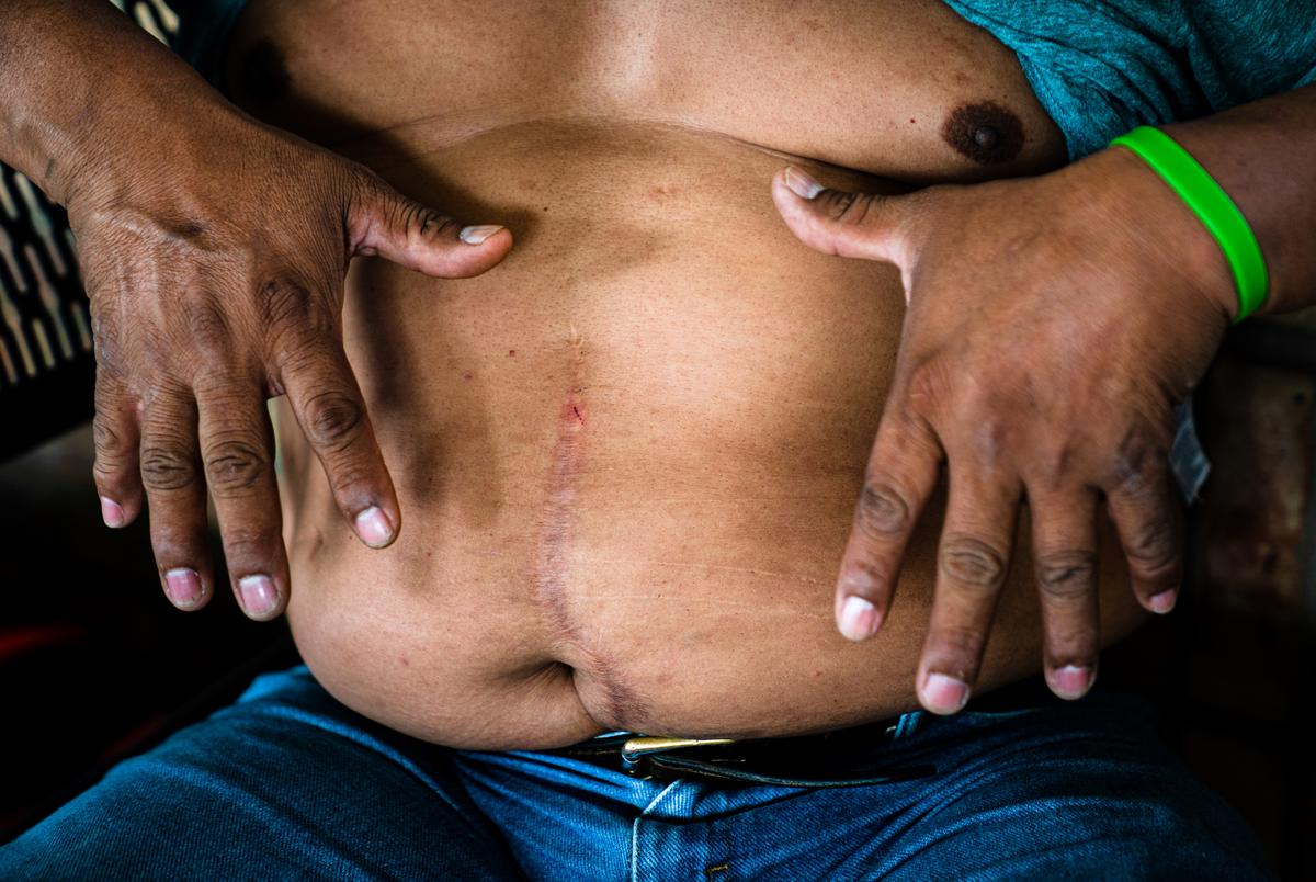 Guatemalan asylum seeker Jorge Mario Gonzalez, 52, shows his scars from a surgery he had after being shot in his country at the bus station in Brownsville, Texas on Feb. 25, 2021. Gonzalez says that he had been shot near the ribs and the bullet went through his body affecting a nerve and as a result, he needs crutches to walk. He and his wife were sent back to Mexico to wait for their asylum cases to be decided in the U.S. in July of 2019 under the Migrant Protection Protocols, MPP. They lived in the city but due to financial issues, they had been living at the migrant camp for nearly a year. They were among the first group to be processed into the U.S.