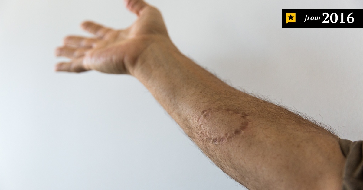 Commission Wants Restriction of Bite Mark Evidence The Texas Tribune