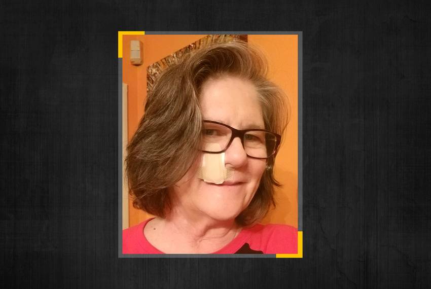 Susan Carson of Dallas wears a bandage from a previous surgery to remove skin cancer, but when a recent biopsy came back c...