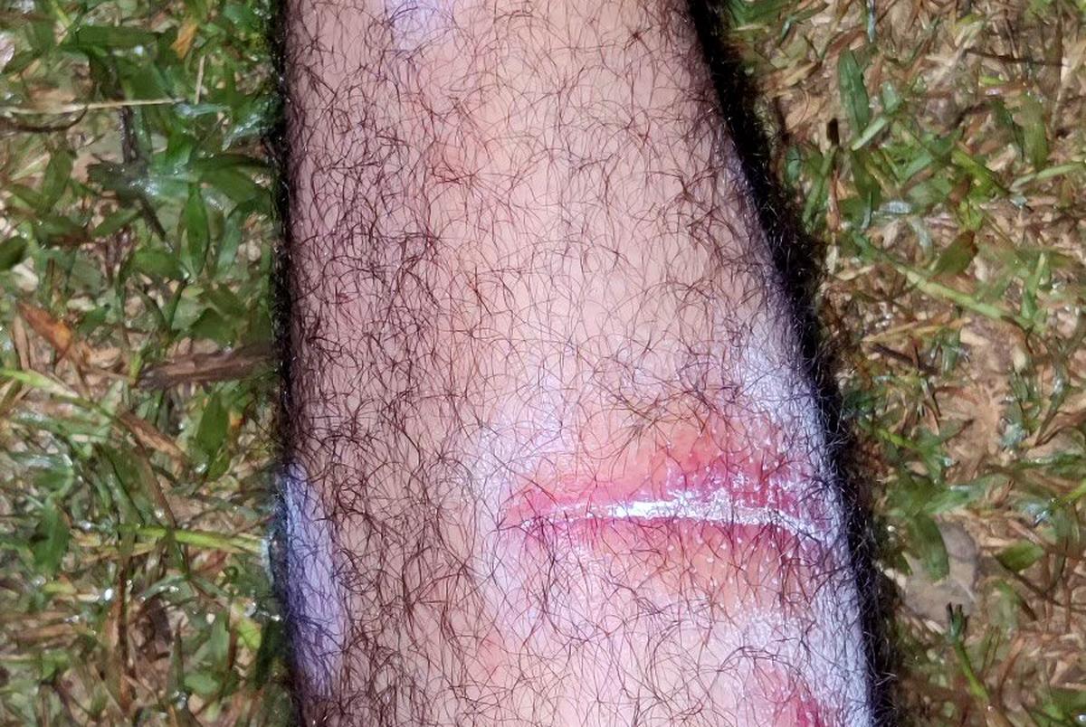 Abdul Wasi Safi took a photo of his injured leg after he said Panamanian police beat him and poured insect-repellant powder on his open wounds.