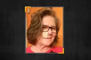 Susan Carson of Dallas wears a bandage from a previous surgery to remove skin cancer, but when a recent biopsy came back cancerous, the doctor's office refused to schedule her surgery. 